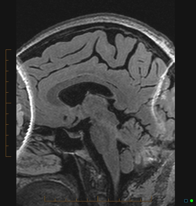 Aliasing artifact causing a spurious cerebellar lesion (Radiopaedia 48783-53810 Sagittal FLAIR 37).jpg