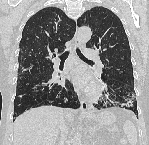 Alpha-1-antitrypsin deficiency (Radiopaedia 72058-82557 Coronal lung window 47).jpg