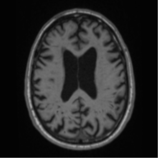 Alzheimer's disease- with Gerstmann syndrome and dressing apraxia (Radiopaedia 54882-61150 Axial T1 48).png