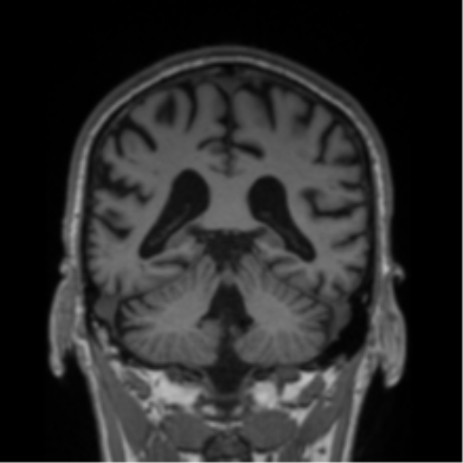Alzheimer's disease- with Gerstmann syndrome and dressing apraxia (Radiopaedia 54882-61150 Coronal T1 33).png