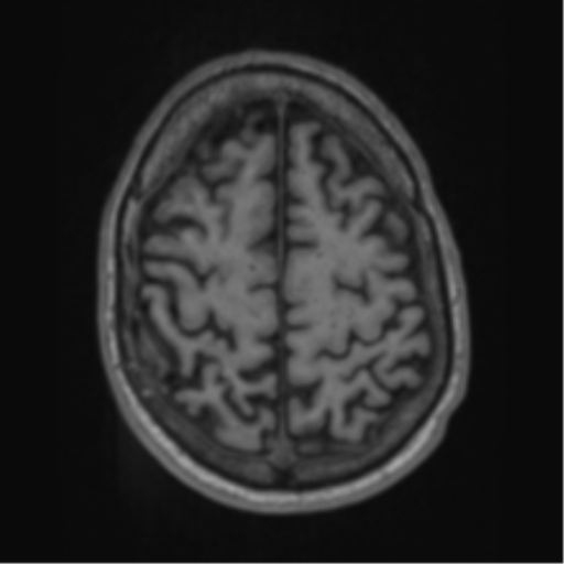 File:Alzheimer's disease- with apraxia (Radiopaedia 54763-61011 Axial T1 59).png