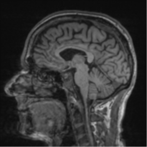 File:Alzheimer's disease- with apraxia (Radiopaedia 54763-61011 Sagittal T1 33).png