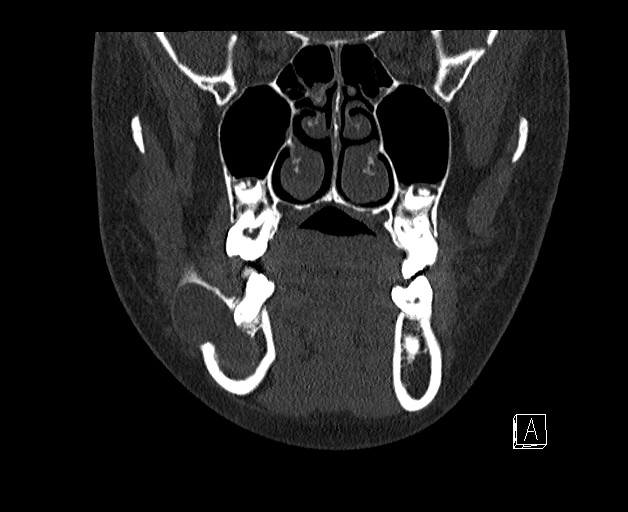 File:Ameloblastoma (Radiopaedia 26645-26793 bone window 3).jpg