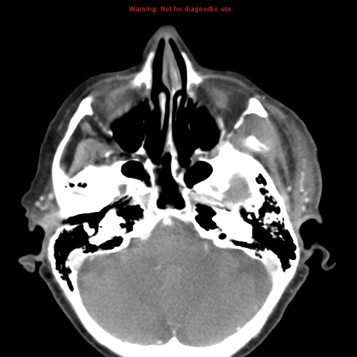 File:Ameloblastoma (Radiopaedia 27437-27631 A 7).jpg