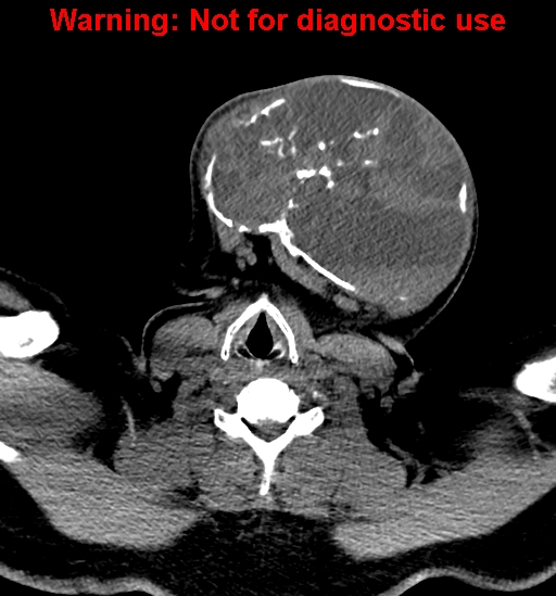 File:Ameloblastoma (Radiopaedia 33126-34164 A 26).jpg