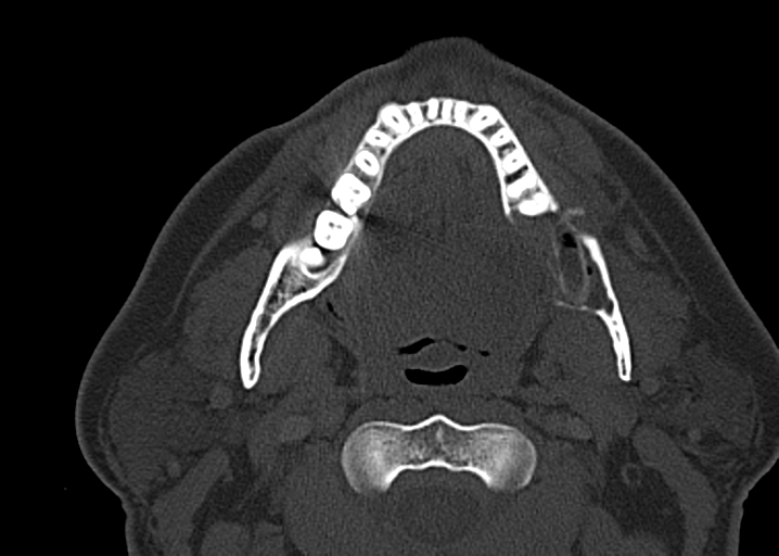 Ameloblastoma (Radiopaedia 38520-40623 D 30).png