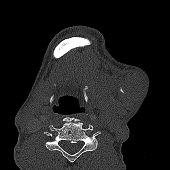 Ameloblastoma (Radiopaedia 51921-57766 Axial bone window 21).jpg