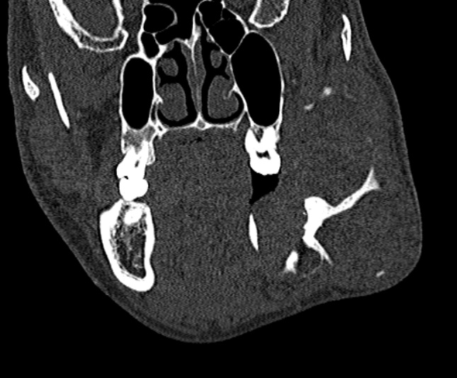 Ameloblastoma (Radiopaedia 51921-57766 Coronal bone window 101).jpg