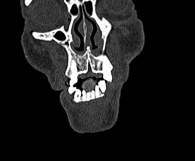 Ameloblastoma (Radiopaedia 51921-57766 Coronal bone window 23).jpg