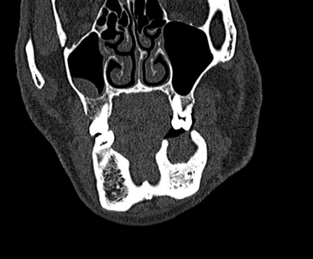 Ameloblastoma (Radiopaedia 51921-57766 Coronal bone window 66).jpg