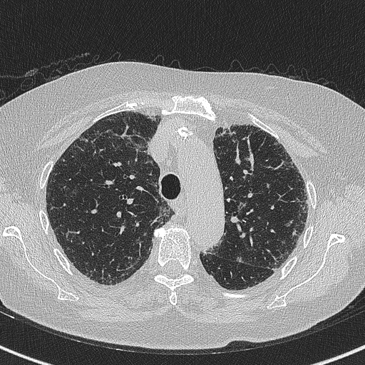 File:Amiodarone-induced pulmonary fibrosis (Radiopaedia 82355-96460 Axial lung window 21).jpg