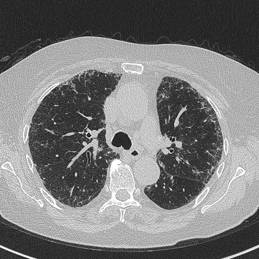 Amiodarone-induced pulmonary fibrosis (Radiopaedia 82355-96460 Axial lung window 26).jpg