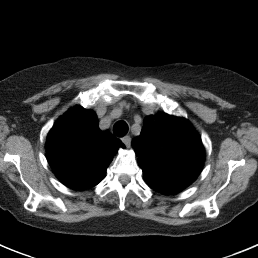 File:Amiodarone-induced pulmonary fibrosis (Radiopaedia 82355-96460 Axial non-contrast 15).jpg