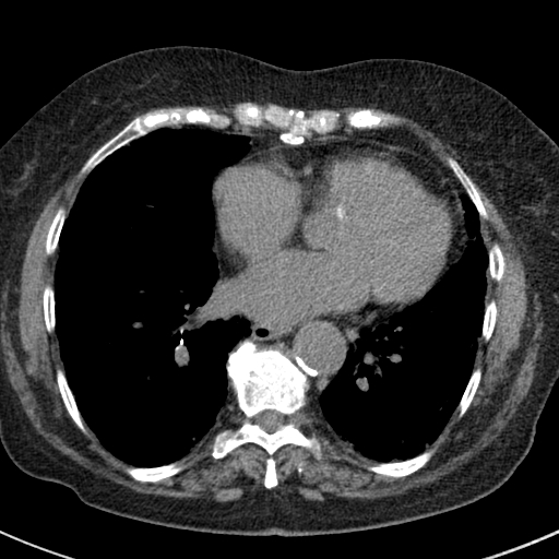 File:Amiodarone-induced pulmonary fibrosis (Radiopaedia 82355-96460 Axial non-contrast 40).jpg
