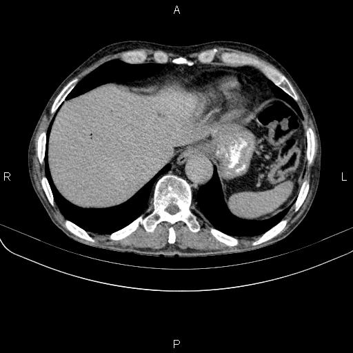 Ampullary adenocarcinoma (Radiopaedia 86093-102033 Axial C+ delayed 16).jpg