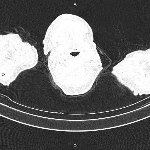 Ampullary adenocarcinoma (Radiopaedia 86093-102033 Axial lung window 1).jpg