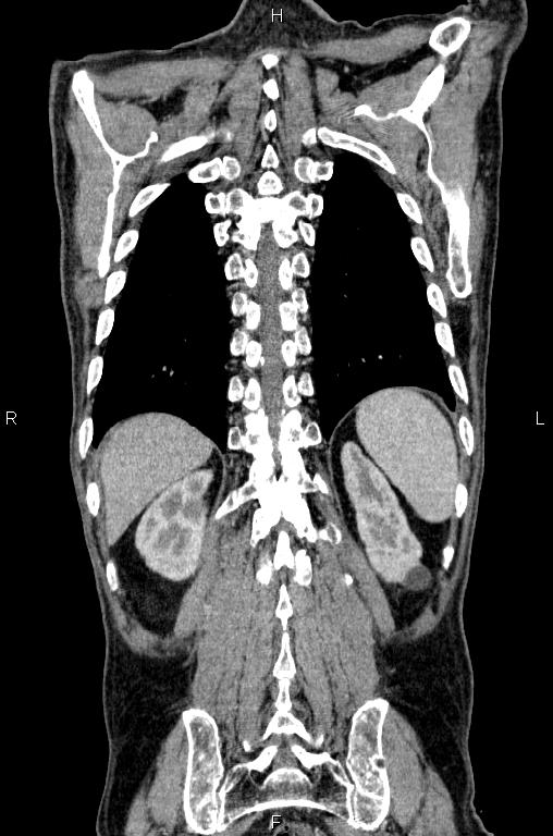 Ampullary adenocarcinoma (Radiopaedia 86093-102033 D 51).jpg