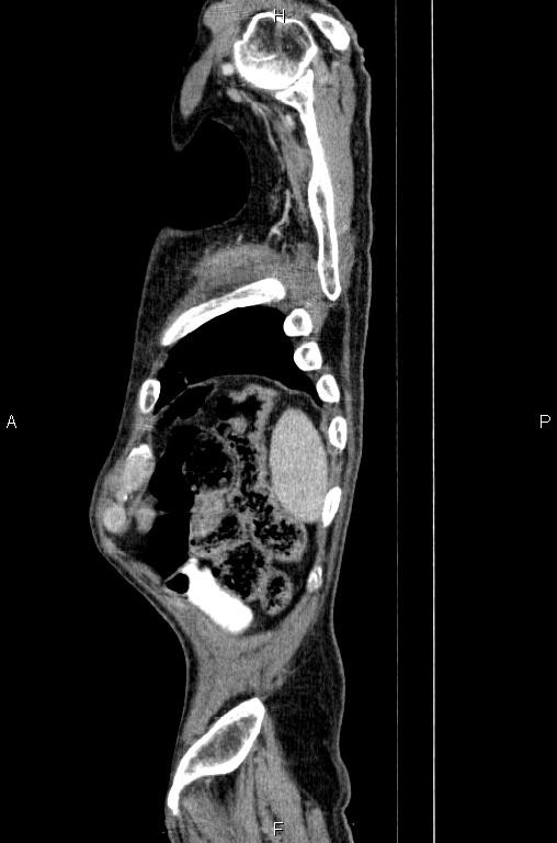 Ampullary adenocarcinoma (Radiopaedia 86093-102033 E 87).jpg