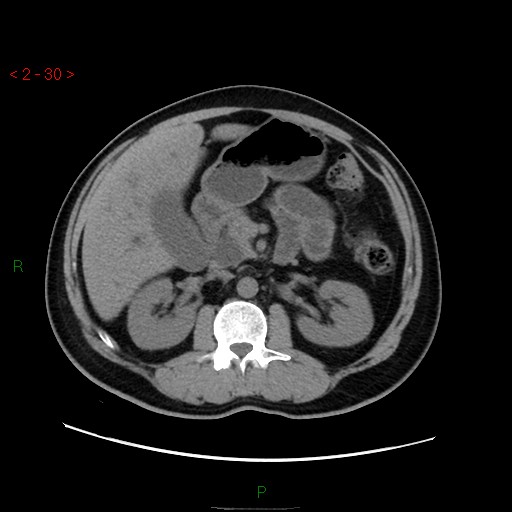 File:Ampullary carcinoma (Radiopaedia 56396-63056 Axial non-contrast 20).jpg