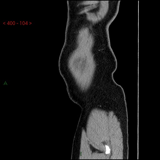 Ampullary carcinoma (Radiopaedia 56396-63056 D 103).jpg