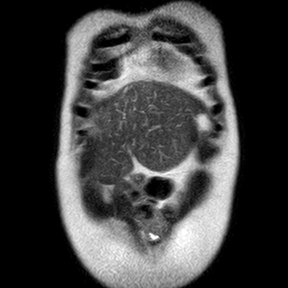 File:Ampullary tumor (Radiopaedia 27294-27479 Coronal T2 2).jpg