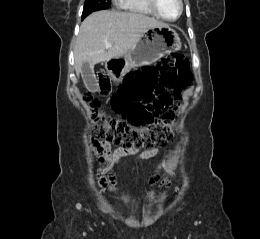 File:Ampullary tumor (Radiopaedia 60333-67998 B 15).jpg