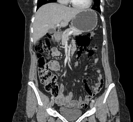 File:Ampullary tumor (Radiopaedia 60333-67998 B 29).jpg