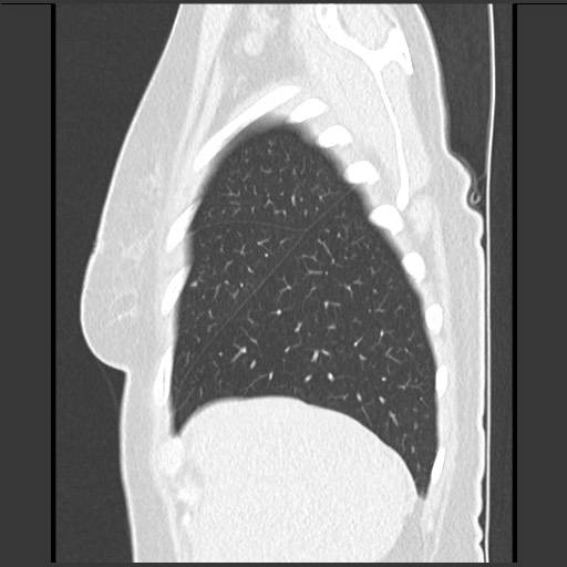 File:Amyloidosis - bronchial and diffuse nodular pulmonary involvement (Radiopaedia 60156-67744 F 9).jpg