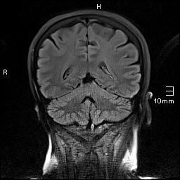 File:Amyotrophic lateral sclerosis (Radiopaedia 70821-81017 Coronal FLAIR 19).jpg