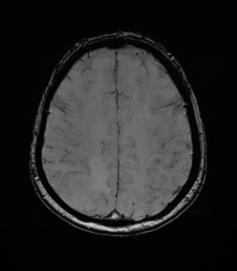 Anaplastic astrocytoma (Radiopaedia 86943-103160 Axial SWI 64).png