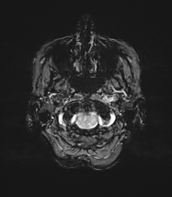 File:Anaplastic astrocytoma (Radiopaedia 86943-103160 Axial SWI 9).png
