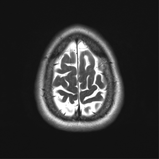 File:Anaplastic astrocytoma - thalamic glioma (Radiopaedia 59709-67115 Axial T2 33).png