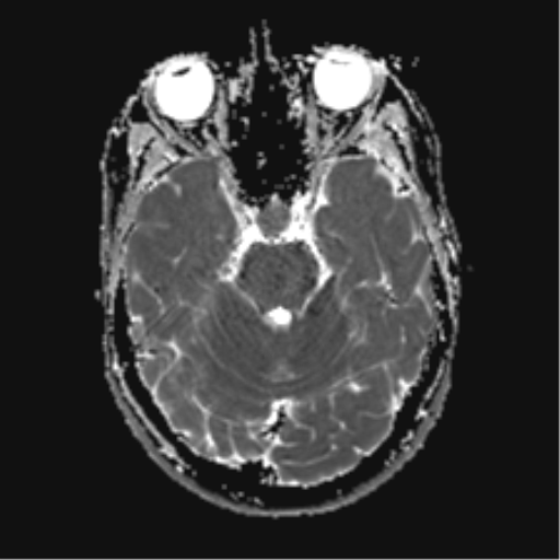 File:Anaplastic astrocytoma IDH mutant (Radiopaedia 50046-55341 Axial ADC 9).png