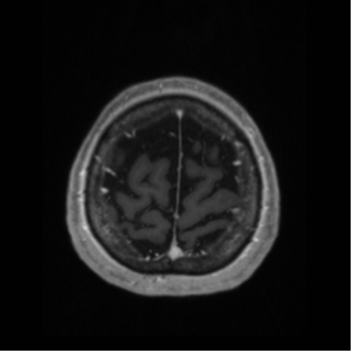 File:Anaplastic astrocytoma IDH wild-type (pseudoprogression) (Radiopaedia 42209-45276 Axial T1 C+ 129).png