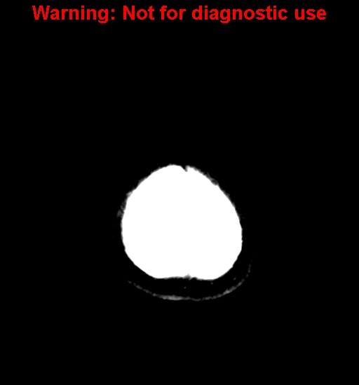 File:Anaplastic ganglioglioma (Radiopaedia 44921-48815 B 30).jpg