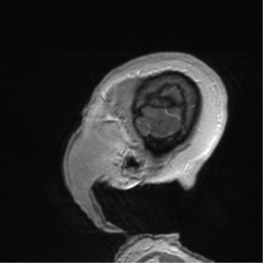 Anaplastic oligodendroglioma (Radiopaedia 83500-98599 Sagittal T1 C+ 58).png