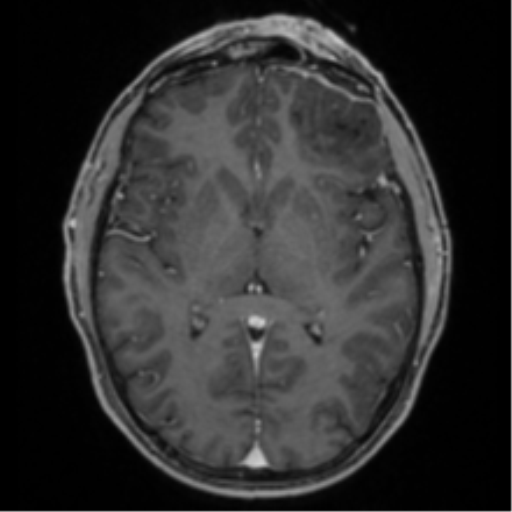Anaplastic oligodendroglioma with skull fracture (Radiopaedia 74831-85845 Axial T1 C+ fat sat 32).png