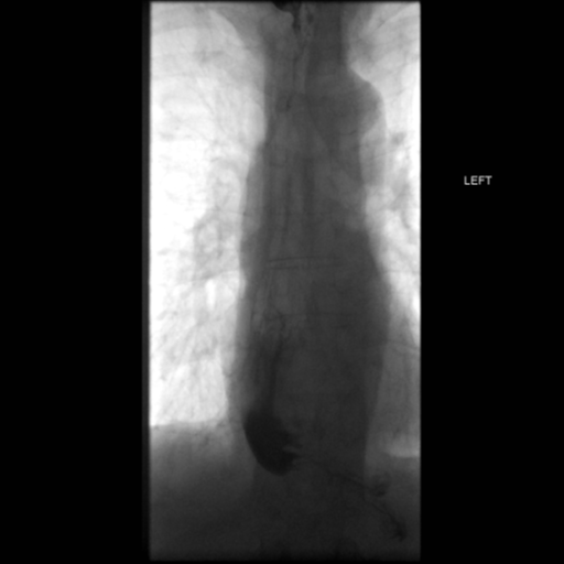 File:Anastomotic stricture post Ivor Lewis esophagectomy (Radiopaedia 47937-52715 B 51).png