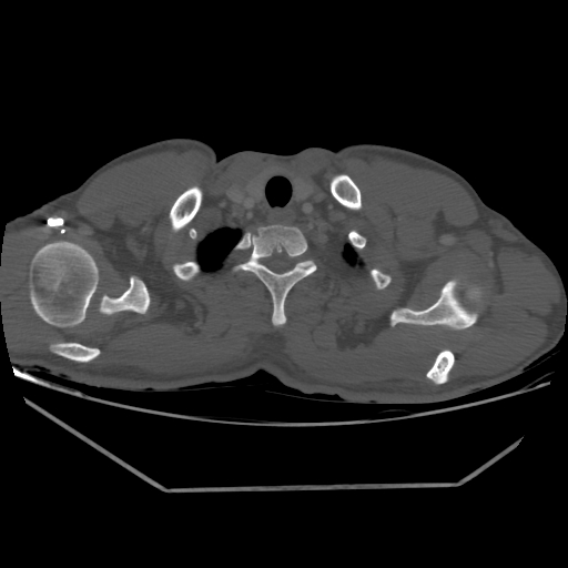 Aneurysmal bone cyst - rib (Radiopaedia 82167-96220 Axial bone window 40).jpg