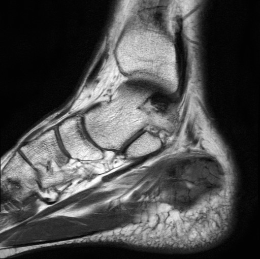 File:Aneurysmal bone cyst of the calcaneus (Radiopaedia 60669-68420 Sagittal T1 16).jpg