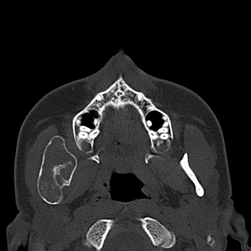 Aneurysmal bone cyst of the mandible (Radiopaedia 43280-46601 Axial bone window 53).jpg