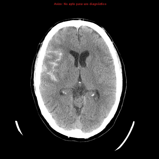 File:Aneurysmal subarachnoid hemorrhage (Radiopaedia 24740-24997 Axial non-contrast 21).jpg