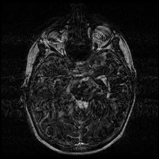 Angioinvasive aspergillosis in the pituitary fossa (Radiopaedia 39676-42010 Ax 3D FIESTA VOLUME 60).png