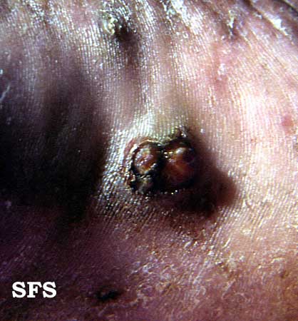 Angiosarcoma (Dermatology Atlas 3).jpg