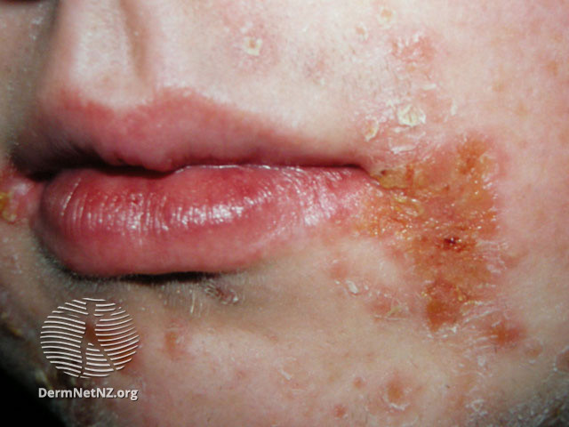 File:Angular cheilitis (DermNet NZ site-age-specific-perleche14).jpg