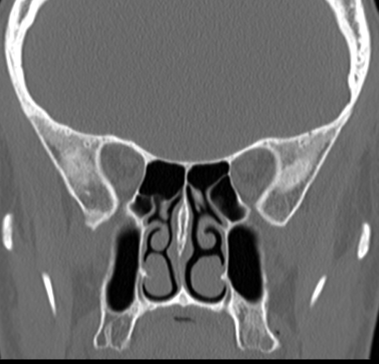 Angular epidermoid cyst (Radiopaedia 46908-51439 Coronal bone window 37).png