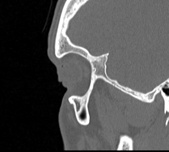 Angular epidermoid cyst (Radiopaedia 46908-51439 Sagittal bone window 4).png