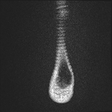 Ankle syndesmotic injury (Radiopaedia 69066-78837 Coronal PD fat sat 3).jpg