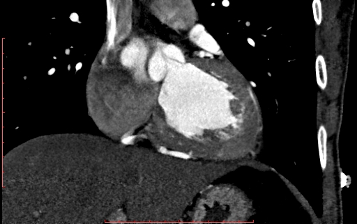 Anomalous left coronary artery from the pulmonary artery (ALCAPA) (Radiopaedia 70148-80181 B 148).jpg