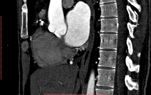 Anomalous left coronary artery from the pulmonary artery (ALCAPA) (Radiopaedia 70148-80181 C 106).jpg